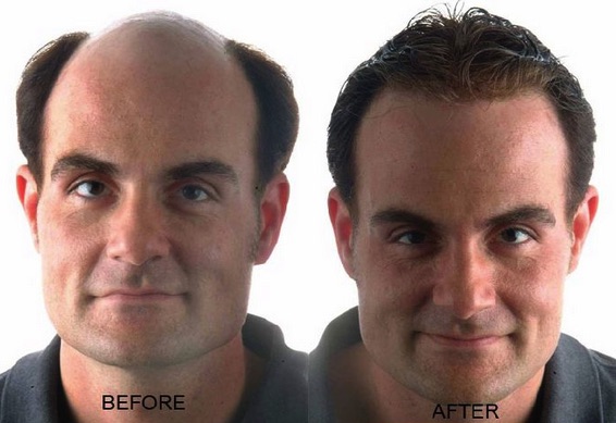 how to regrow hair loss naturally